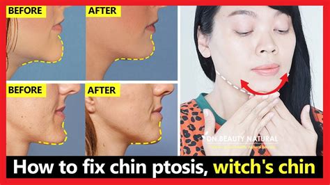 Witches chin